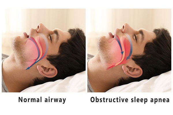 Sleep Apnea Treatments